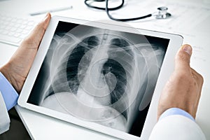 Doctor observing a chest radiograph in a tablet photo