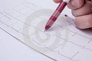 Doctor in the office indicates the patient using a ballpoint pen on segment with the pathology, detected on electrocardiogram ECG