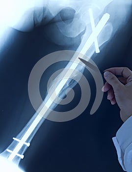 Doctor orthopedist examine x-ray photo