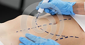 Doctor plastic surgeon drawing preoperative markings on skin of patient abdomen 4k movie