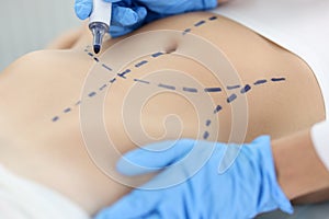 Doctor plastic surgeon drawing preoperative markings on skin of patient abdomen closeup