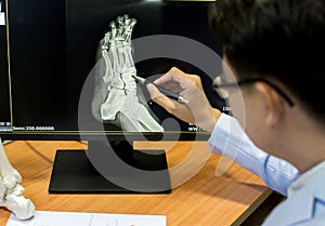 Doctor pointing on the foot problem point on x-ray film. x-ray film show skeleton foot on film.