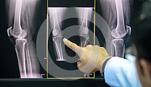 Doctor pointing on the knee problem point on x-ray film. x-ray film show skeleton knee on film. Surgery medical technology concept