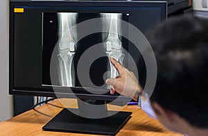 Doctor pointing on the knee problem point on x-ray film. x-ray film show skeleton knee on film. Surgery medical technology concept