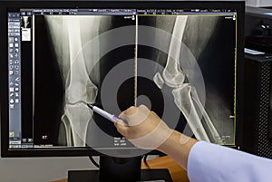 Doctor pointing on the knee problem point on x-ray film. x-ray film show skeleton knee on film. Surgery medical technology concept