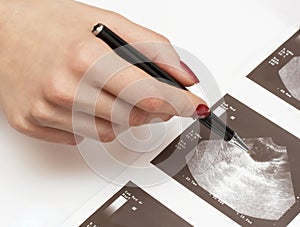 Doctor pointing at ovary ultrasound photo