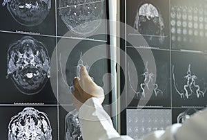Doctor pointing to brain anatomy on MRI image