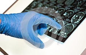 Doctor pointing at x-ray image