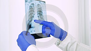 Doctor points finger at x-ray of lungs,hand gestures,body language,medical worker diagnoses human lung pneumonia,close-up.
