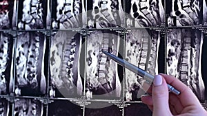 Doctor points on magnetic resonance imaging of the lumbar spine