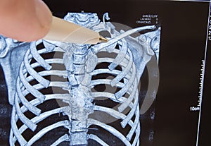 Doctor points out pen on clavicle in picture of 3D computer tomography. Anatomical location of collarbone and frequent destination