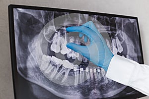 Doctor points to filled root canal in dental x-ray