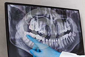 Doctor points wisdom tooth in dental x-ray.
