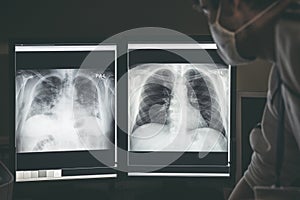 Doctor radiologist looking at difference between healthy and damaged lungs on x-ray image of patient with coronavirus Covid-19