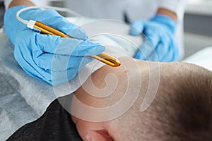 A doctor removes a wart from a man& x27;s neck, close-up
