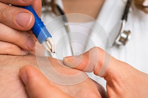 Doctor removing a tick with tweezers from hand of patient