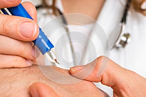 Doctor removing a tick with tweezers from hand of patient