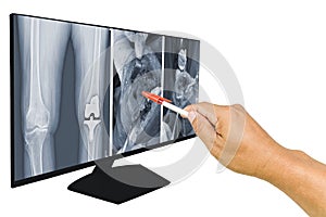 The doctor reported  x-ray knee operation Case severe bone loss varus knee s/p Left Total Knee ArthroplastyTKA0 with bone graft