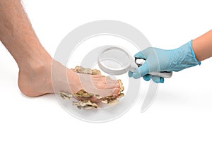 A doctor in rubber gloves examines a patient`s foot with foot fungus through a magnifying glass, white isolated background, close