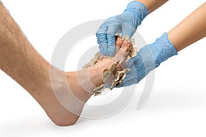 A doctor in rubber gloves examines a patient`s foot with foot fungus, white isolated background, close-up