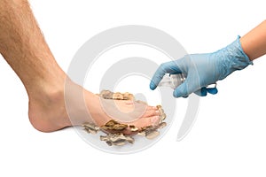 A doctor in rubber gloves treats a patient`s foot with foot fungus, white isolated background, close-up
