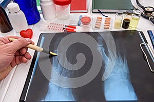 Doctor`s hand pointing at x-ray on the table