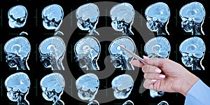 Doctor's hand points to a set of MRI scans of the human skull and brain, with cerebral malformations, preliminary diagnosis,