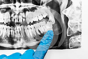 A doctor`s hand in a protective medical glove points with a finger at the growth of wisdom teeth in the lower jaw on an X-ray