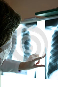 In the doctor`s office - lung radiography photo