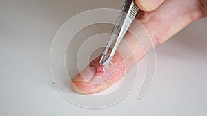 Doctor scrapes a skin with tweezers for analysis. Male fingers with psoriasis and eczema