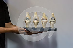 Doctor show anatomical model of knee displaying progression of knee osteoarthritis which ending up in Total Knee Replacement surge photo