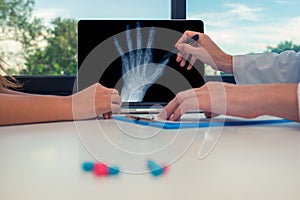 Doctor showing a x-ray of a left hand on a laptop to a woman patient. Osteoarthritis concept