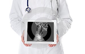 Doctor showing x-ray of patient with cancer on tablet against background, closeup