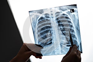 Doctor showing x-ray of patient's lungs.