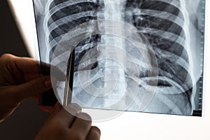 Doctor showing x-ray of patient's lungs.