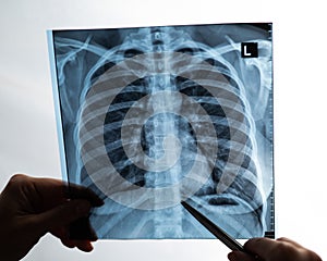 Doctor showing x-ray of patient's lungs.