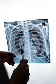Doctor showing x-ray of patient& x27;s lungs.