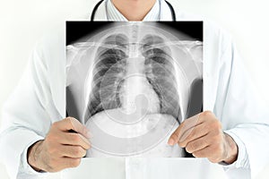 Doctor showing x-ray image of normal man chest