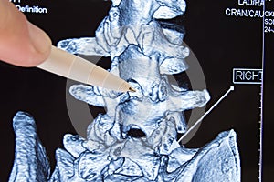 Doctor shows on CT MRI scans place in spine between vertebrae, which is procedure of epidural anesthesia or spinal puncture conduc