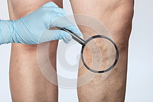 Doctor shows the dilation of small blood vessels of the skin on the leg. Medical inspection and treatment of Telangiectasia,