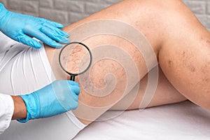 Doctor shows  the dilation of small blood vessels of the skin on the leg. Medical inspection and treatment of Telangiectasia.