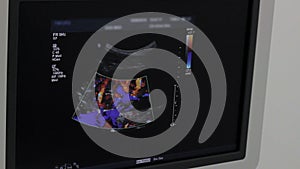Doctor shows on monitor kidney artery ultrasound examination color, close-up