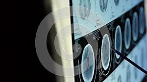 Doctor study head pet/ct scan for analysis the disease,skull brain X-ray.