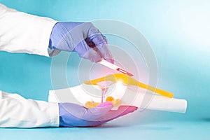 Doctor surgeon holds a scalpel near the knee joint mockup on a blue background. The concept of joint replacement surgery,