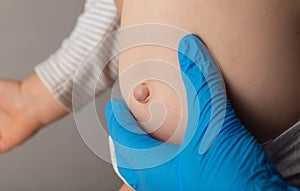 A doctor surgeon in medical gloves examines the abdomen of a newborn baby with an enlarged umbilical ring and an