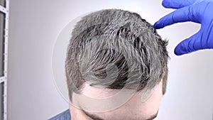 Doctor trichologist in blue medical gloves examines the gray hair of a young man. The concept of early graying of hair in young pe