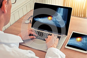 Doctor watching a laptop with x-ray of pain relief on the top of a foot in a medical office