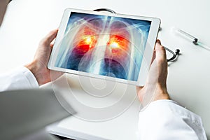 Doctor watching a xray of lung cancer on digital tablet. Radiology concept