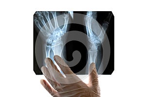 A doctor in white gloves examines an X-ray of a damaged hand. Close-up. Concept on a medical theme, day of radiologist or surgeon