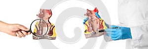 Doctors demonstrating anatomical models of rectum with hemorrhoids on white background, closeup. Collage photo